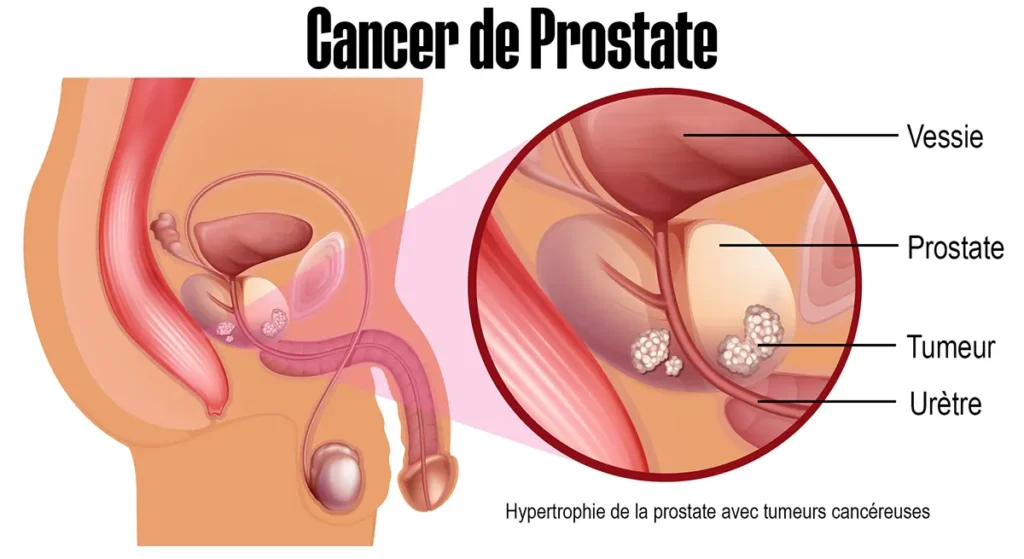 Éjaculer plus souvent réduirait les risques de cancer de la prostate, selon une étude de l'université Harvard